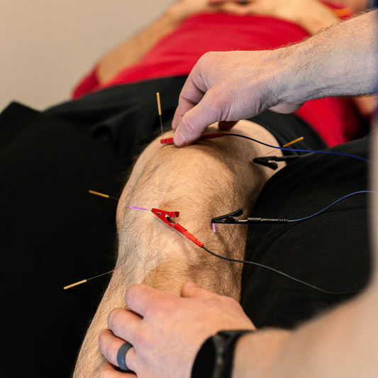 dry-needling